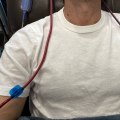 What to Expect During and After Treatment for Extracorporeal Blood Oxygenation and Ozonation